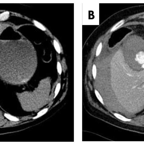 Haemorrhagic Corpus Luteal Cyst Intravenous Contrast Enhanced Axial