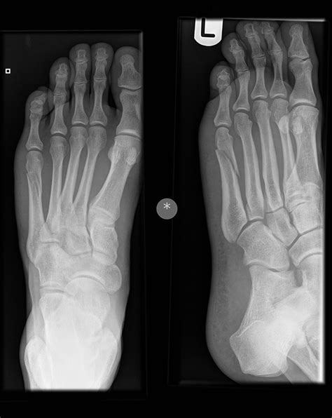 My Left Foot Spiral Fracture Shaft Of 5th Metatarsal Samwebster