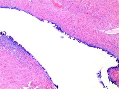 Pathology Outlines Serous Cystadenoma Adenofibroma And Surface Papilloma