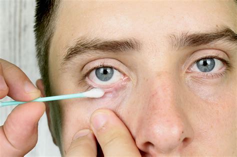 Глазной Клещ Симптомы И Лечение Фото Telegraph