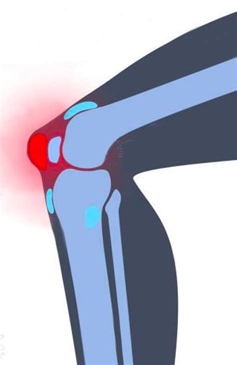 Fiches Genou Drs Riouach Et Caumon Orthopédiste Montluçon