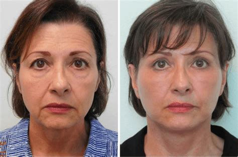 But when hiring experts—like tax pros, doctors and mechanics—we're all for spending more cash to get the job. How Long is Recovery from a Facelift Procedure? | Las ...