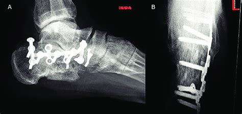 The Lateral A And Axial B Calcaneus Radiographs Are Showing The