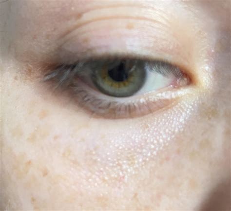 Skin Concerns Under Eye Problem Ive Had These White Bumps For As