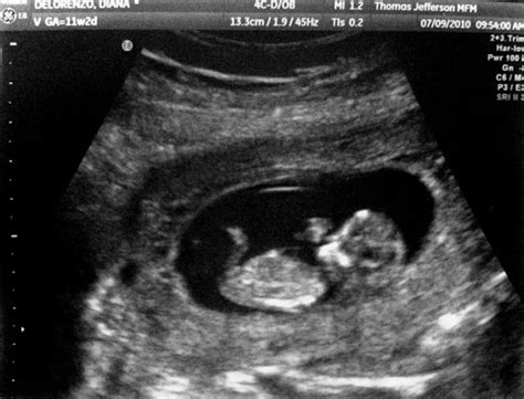 11 Weeks Pregnant Ultrasound, Symptoms, Belly