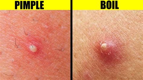 This Is The Difference Between A Pimple And A Boil Youtube