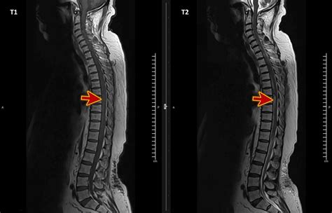 Cureus Acute Spinal Extradural Hematoma And Cord Compression Case The
