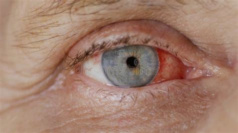 Close Up Woman Eye With Burst Capillaries Cataract Surgery Stock