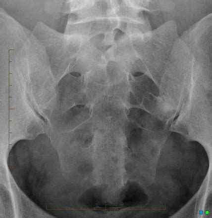 Sacroiliac Joint Pa Sacrum View Radiology Reference Article