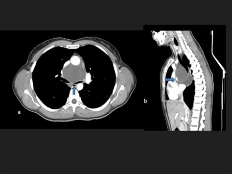 A Axial Contrast Enhanced Ct Shows Cystic Mass In Middle Mediastinum