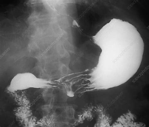 Stomach Ulcer Barium X Ray Stock Image C0041441 Science Photo