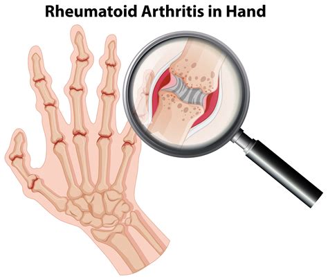 Human Anatomy Rheumatoid Arthritis In Hand 418598 Vector Art At Vecteezy