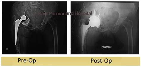 Partial Hip Replacement Sant Parmanand Hospital
