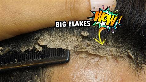 Removing Big Dandruff Flakes From Scalp On Front Side 419 Youtube