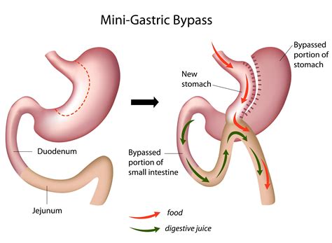 Mini Vs Traditional Gastric Bypass Which Surgery Is Right For Me Gastric Bypass Surgery