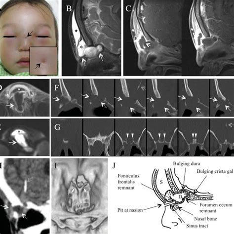 Pdf Nasal Dermal Sinus Associated With A Dumbbell Shaped Dermoid A
