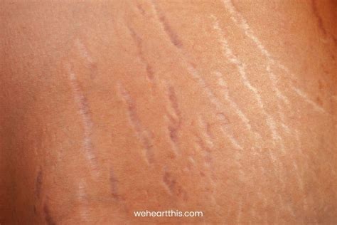 Microneedling For Stretch Marks Benefits Risks And More
