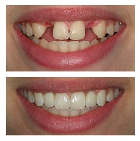 21 Dental Implant Before And After Photos