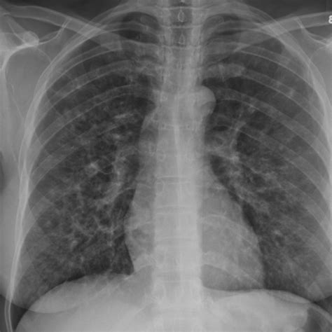 CaseStacks.com - Chest CT Case #16