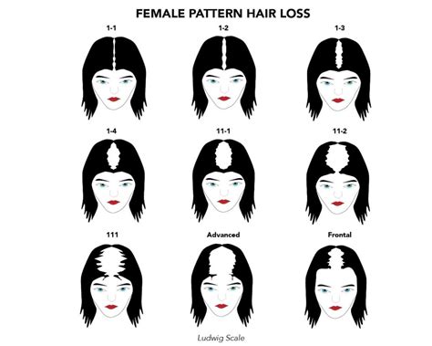 Guide To Female Pattern Baldness Androgenic Alopecia Causes And