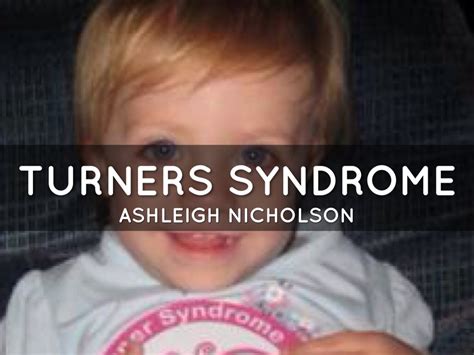 Turners Syndrome By Ashleigh Nicholson