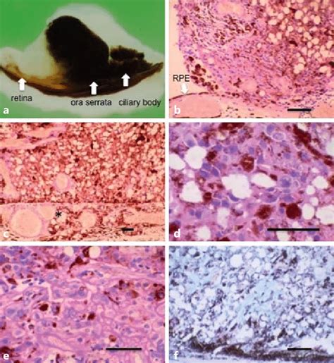 Gross And Light Microscopic Findings Of The Tumor A Gross Appearance