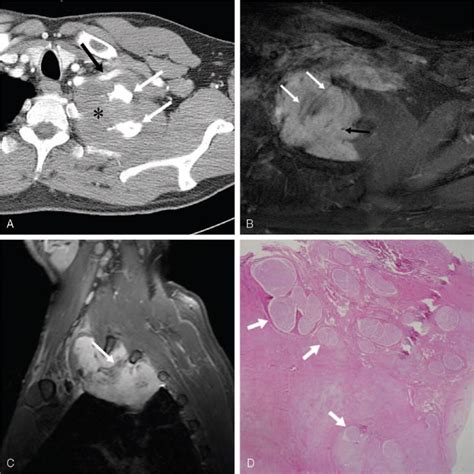 A 47 Year Old Man Presented With Desmoid Type Fibromatosis In The Left