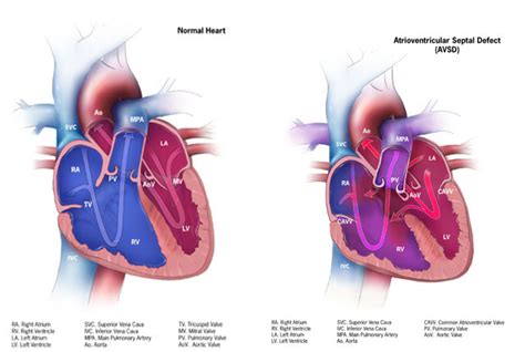 Cdc Congenital Heart Defects Avsd With A Normal Heart Graphic Ncbddd