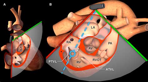 Virtual Tee Using Spectral Doppler To Evaluate The Tricuspid Valve