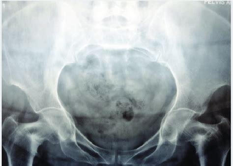 Anteroposterior Pelvis Radiograph Showing Sclerosis Over Bilateral