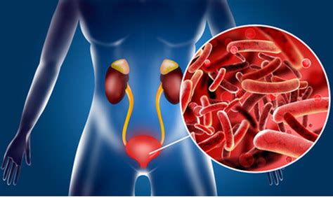 Understanding Urinary Tract Infections UTI Urology Clinics Of North Texas