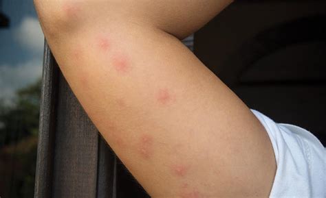 When Bedbugs Bite A Case Study On A Severe Infestation Restoration Remediation