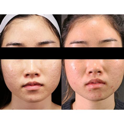 Melbourne Acne Scarring Laser Treatment Which Is The Best Procedure