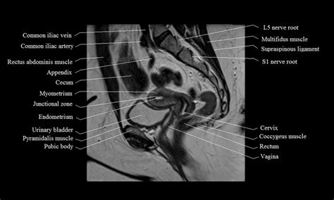 MRI Female Pelvis Anatomy Free MRI Sagittal Cross Sectional Anatomy