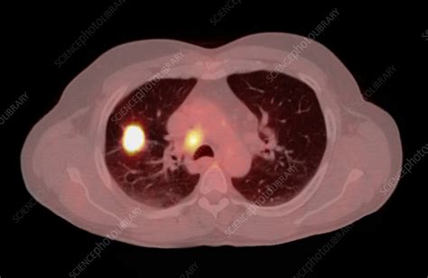 Non Small Cell Lung Cancer Ctpet Scan Stock Image C0071648