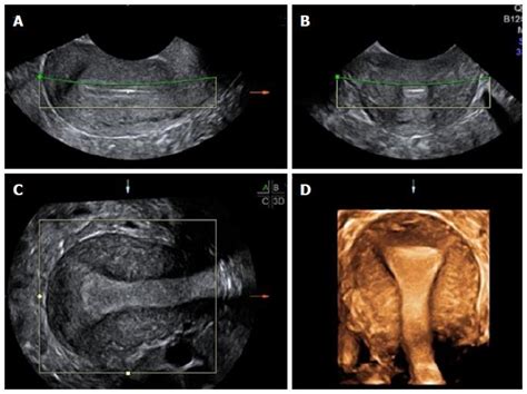 Three Dimensional Imaging Of The Uterus The Value Of The Coronal Plane