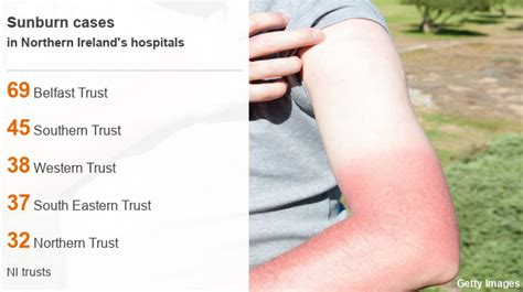 Heatwave Sunburn 220 People Treated In Ni Hospitals Bbc News