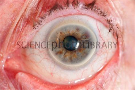Arcus Senilis Of The Eye Close Up Of A White Ring Arcus Senilis