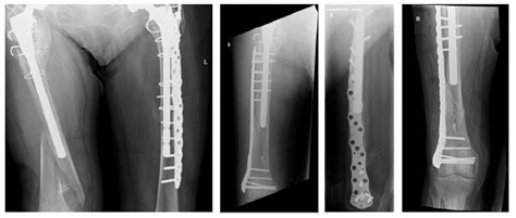 Outcomes Of Surgical Management Of Periprosthetic Fractures Around The