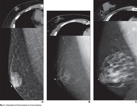 figure 1 from incremental role of mammography in the evaluation of gynecomastia in men who have
