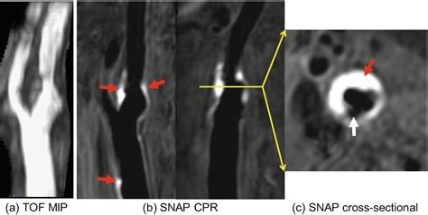 Carotid Vessel Wall Imaging And Future Directions Radiology Key