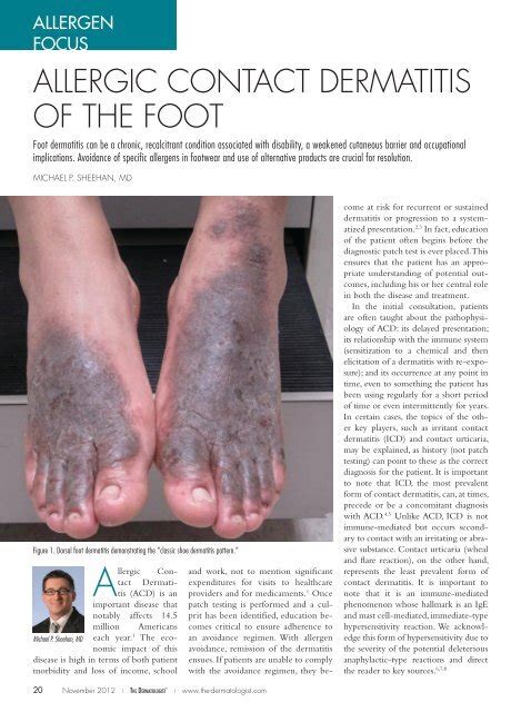 Allergic Contact Dermatitis Of The Foot The Dermatologist