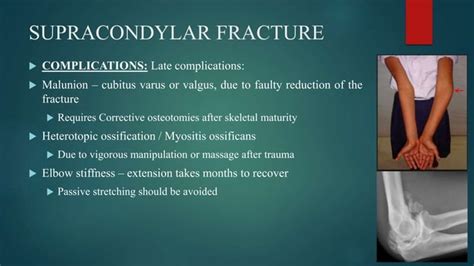 Supracondylar Fracture Of Humerus Ppt