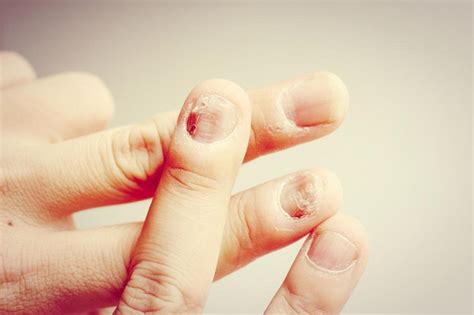 The 6 Most Common Nail Diseases Dino System