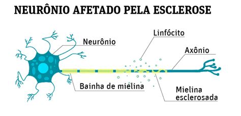 Características clínicas e epidemiológicas de 20 pacientes. Esclerose Múltipla - 09/04/2019 - Esclerose multipla ...