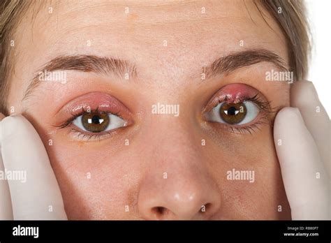 Close Up Picture Of Female Patients Infected Eye Hordeolum On Upper