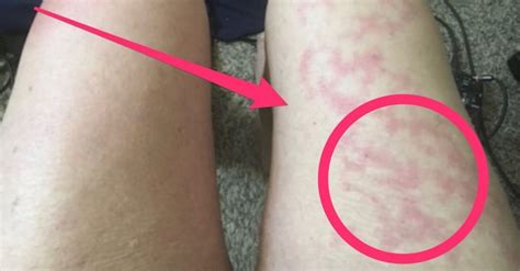 How To Get Rid Of Hives After Covid 19 Laredo Emergency Room
