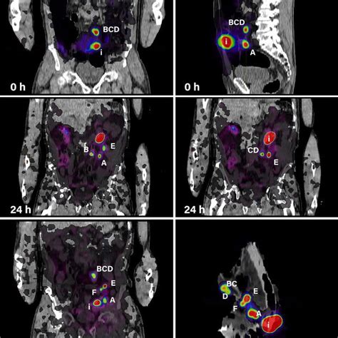 Sentinel Lymph Node Identification By Petct Imaging Over Time