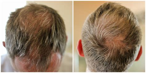 Significant weight loss is another common trigger for telogen effluvium. Hair Thinning and Hair Loss: What's a Man To Do? - Clever ...