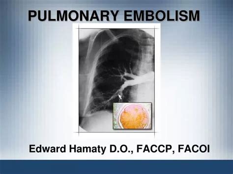 Ppt Pulmonary Embolism Powerpoint Presentation Free Download Id